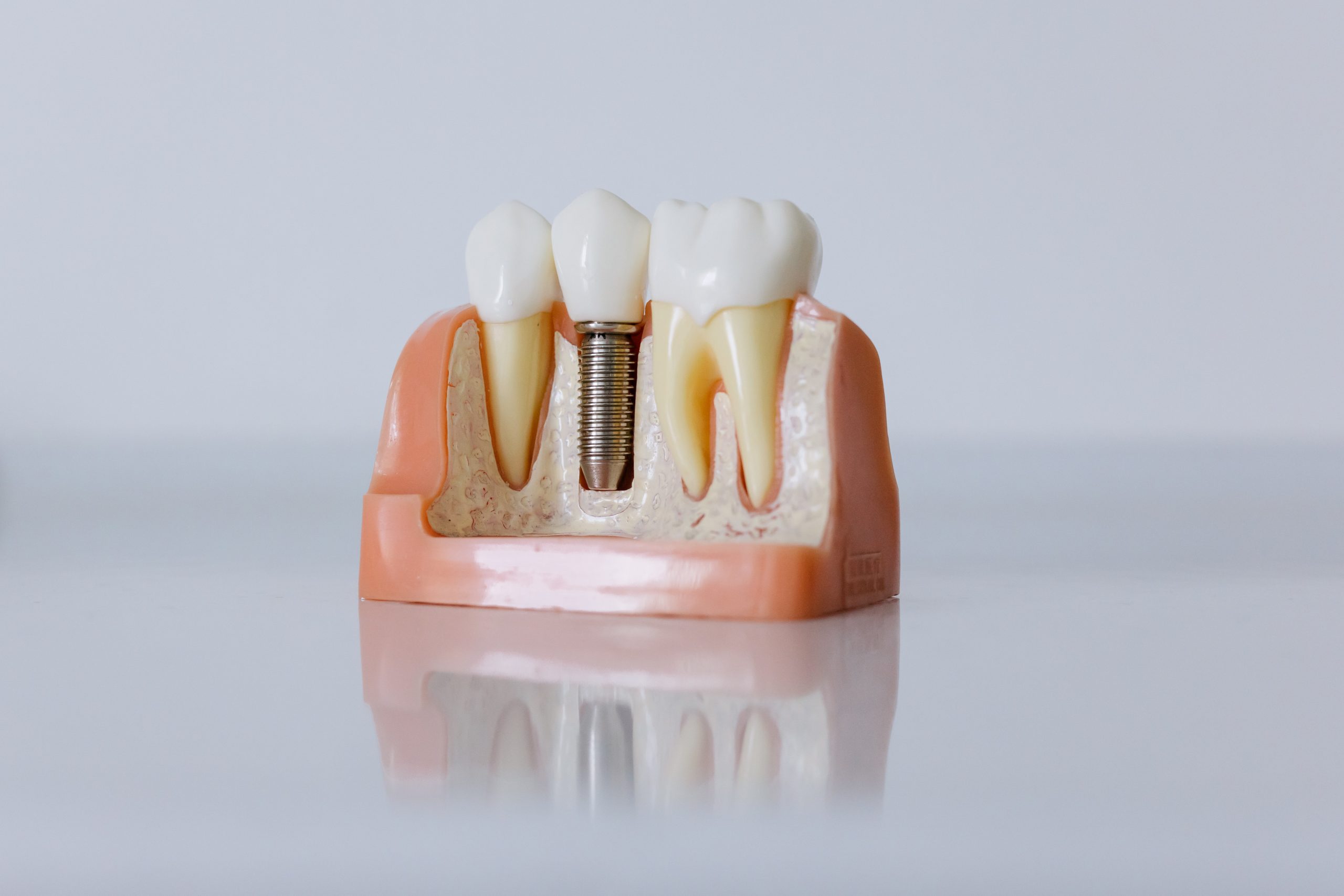 Implantes: Lo que hay que saber antes de elegir los implantes dentales